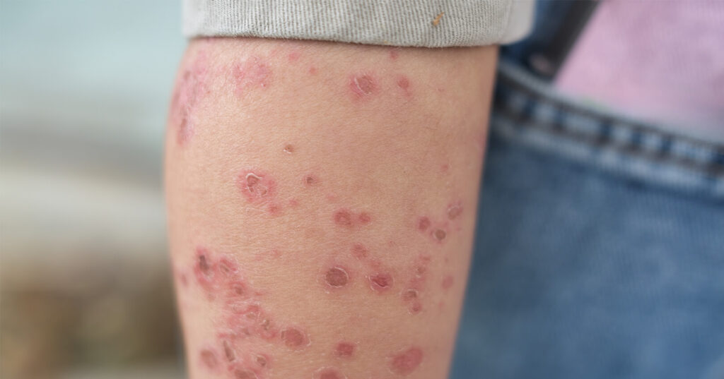 SYPHILIS SYMPTOMS STD